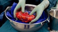 Jual_Ginjal_Bongkar_Jaringan_Hitam_Perdagangan_Organ_Global