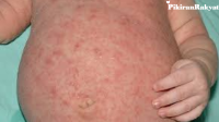 Atasi Gatal Scabies: Penyebab, Pencegahan & Pengobatan Ampuh Atasi Gatal Scabies: Penyebab, Pencegahan & Pengobatan Ampuh