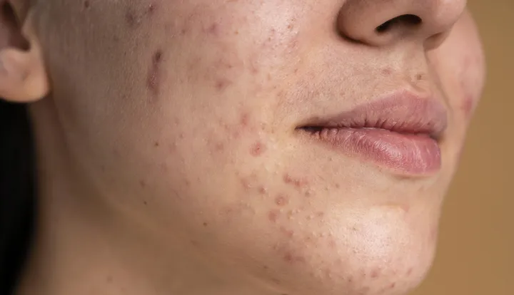 Hilangkan Bopeng Membandel? 5 Serum Ajaib untuk Kulit Mulus