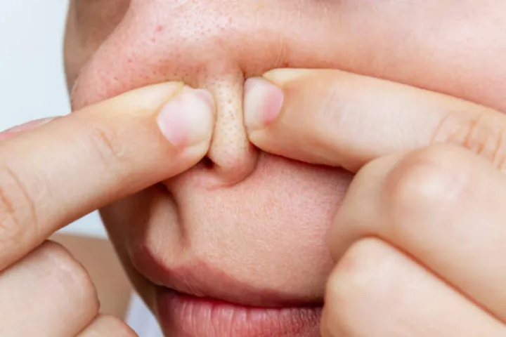 Jangan Pencet! Jerawat Hidung? Risiko, Penyebab & Solusinya