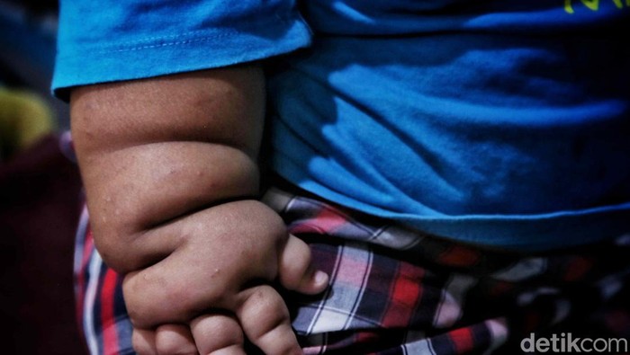Waspada! Obesitas Anak Gen Alpha Ancam Kesehatan Indonesia