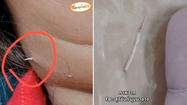 Duri Ikan Nyaris Mematikan: Wanita Ini Hampir Tewas Tersedak